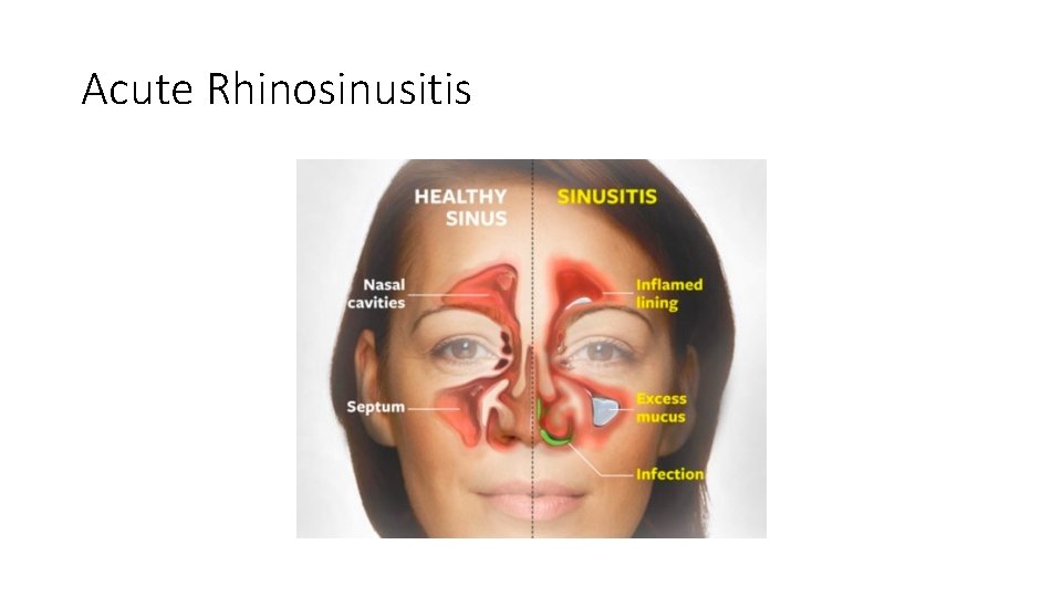 Acute Rhinosinusitis Acute Rhinosinusitis
