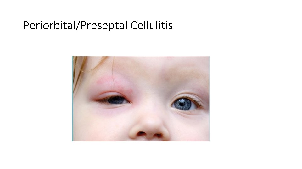 Periorbital/Preseptal Cellulitis Periorbital/Preseptal Cellulitis