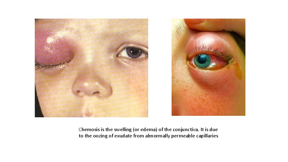 Chemosis is the swelling (or edema) of the conjunctiva. It is due to the Chemosis is the swelling (or edema) of the conjunctiva. It is due to the