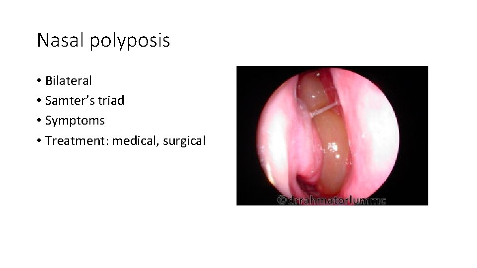 Nasal polyposis • Bilateral • Samter’s triad • Symptoms • Treatment: medical, surgical 