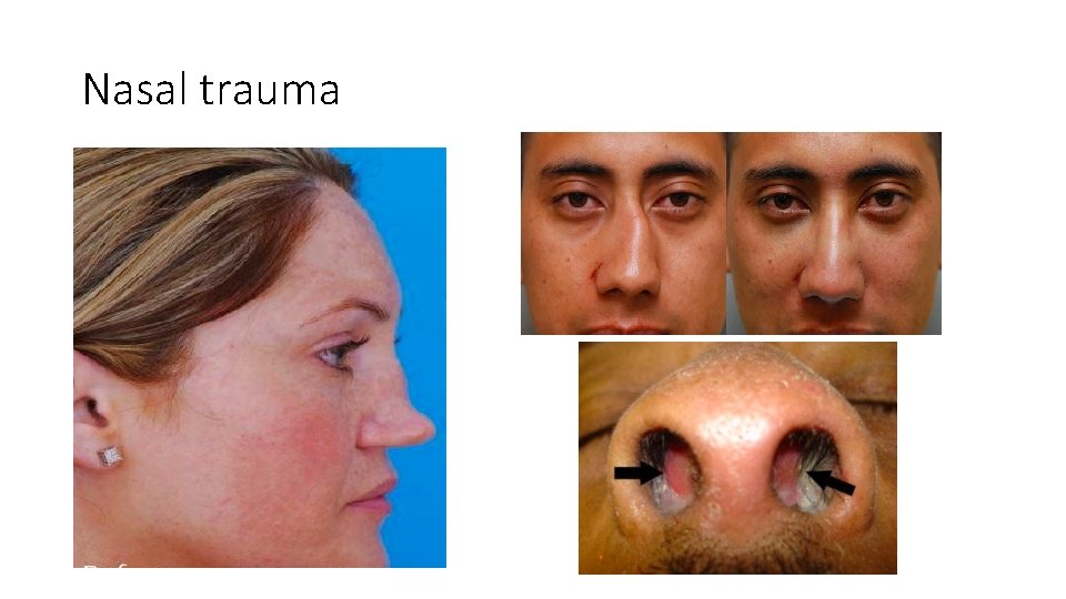 Nasal trauma 