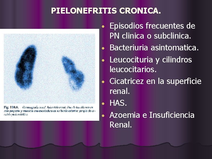 PIELONEFRITIS CRONICA. • • • Episodios frecuentes de PN clinica o subclinica. Bacteriuria asintomatica.