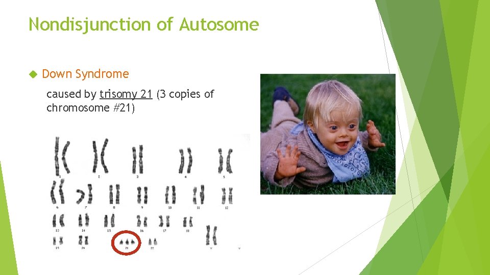 Nondisjunction of Autosome Down Syndrome caused by trisomy 21 (3 copies of chromosome #21)