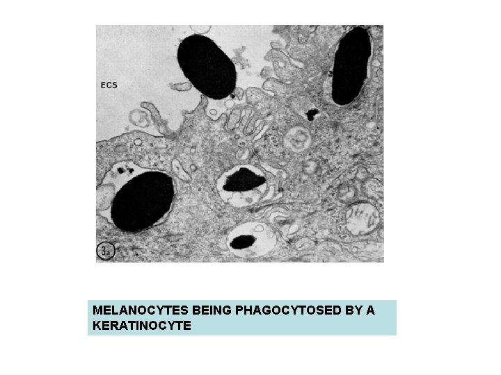 MELANOCYTES BEING PHAGOCYTOSED BY A KERATINOCYTE MELANOCYTES BEING PHAGOCYTOSED BY A KERATINOCYTE