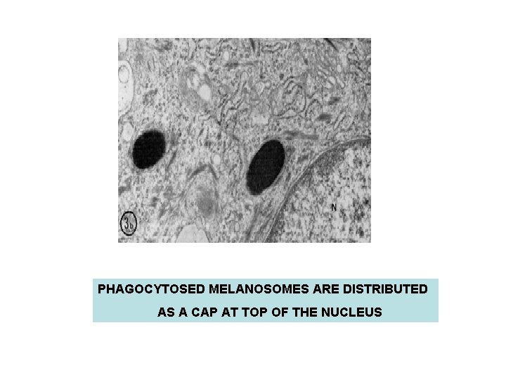 PHAGOCYTOSED MELANOSOMES ARE DISTRIBUTED AS A CAP AT TOP OF THE NUCLEUS PHAGOCYTOSED MELANOSOMES ARE DISTRIBUTED AS A CAP AT TOP OF THE NUCLEUS