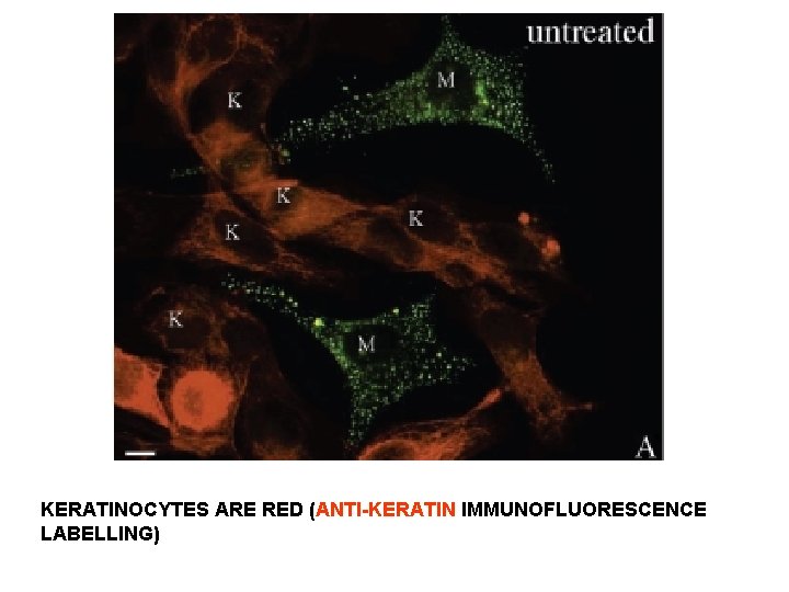 KERATINOCYTES ARE RED (ANTI-KERATIN IMMUNOFLUORESCENCE LABELLING) KERATINOCYTES ARE RED (ANTI-KERATIN IMMUNOFLUORESCENCE LABELLING)