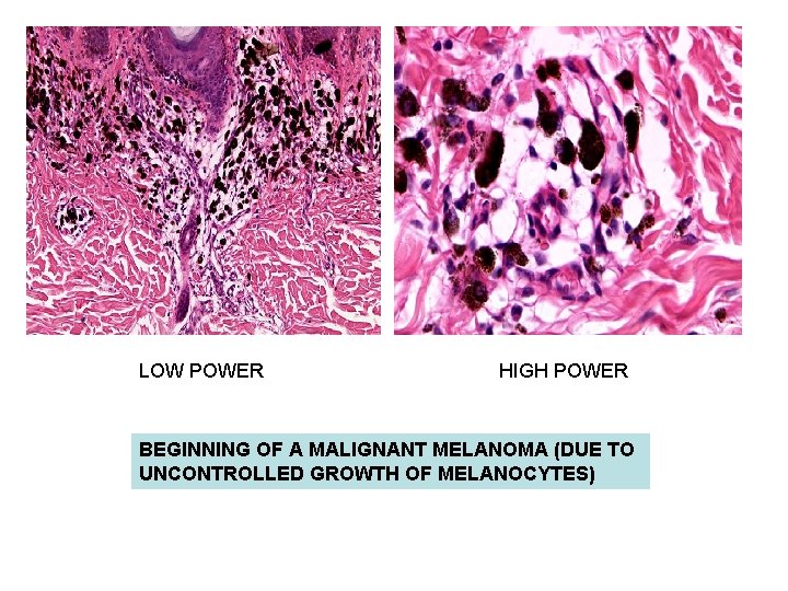 LOW POWER HIGH POWER BEGINNING OF A MALIGNANT MELANOMA (DUE TO UNCONTROLLED GROWTH OF LOW POWER HIGH POWER BEGINNING OF A MALIGNANT MELANOMA (DUE TO UNCONTROLLED GROWTH OF