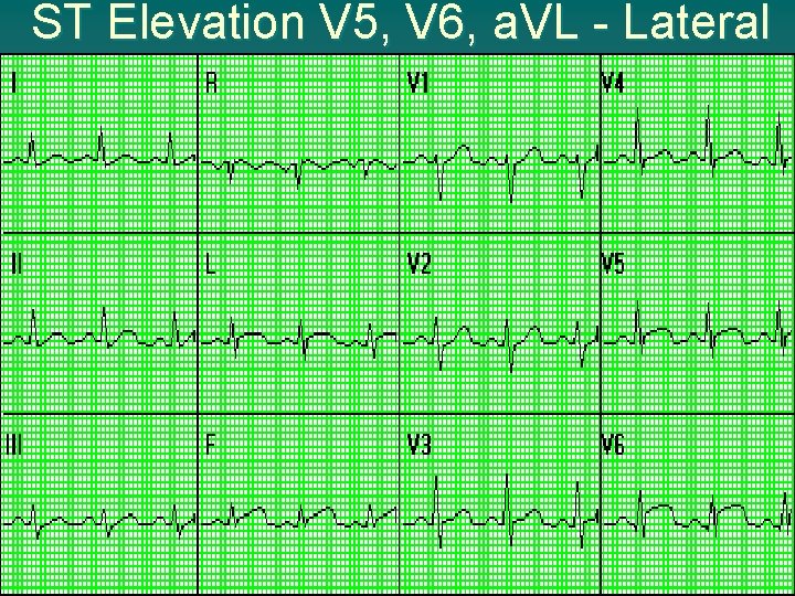 ST Elevation V 5, V 6, a. VL - Lateral 