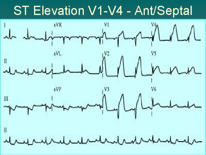 ST Elevation V 1 -V 4 - Ant/Septal 