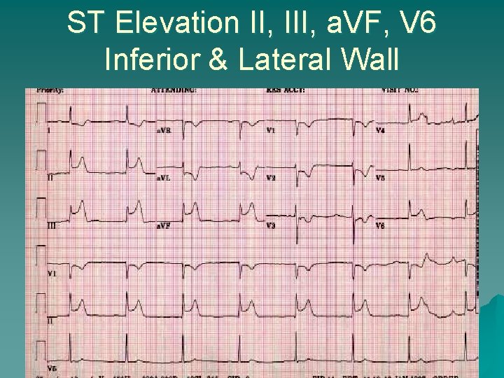 ST Elevation II, III, a. VF, V 6 Inferior & Lateral Wall 