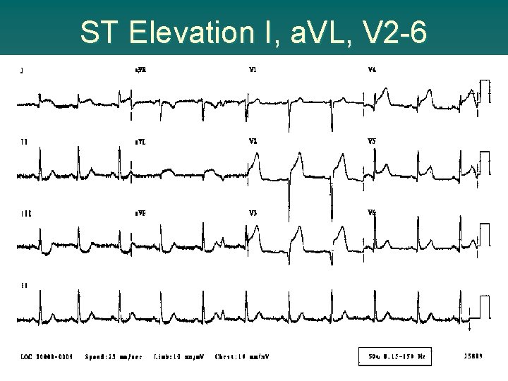 ST Elevation I, a. VL, V 2 -6 