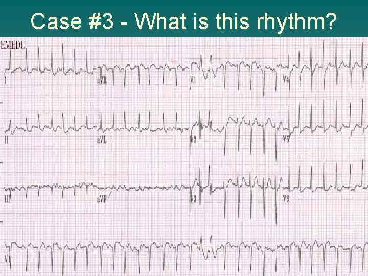 Case #3 - What is this rhythm? 