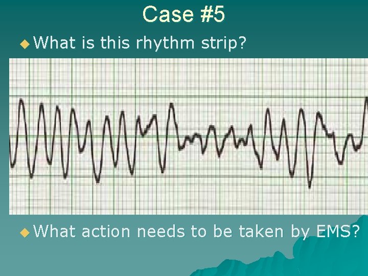 Case #5 u What is this rhythm strip? u What action needs to be
