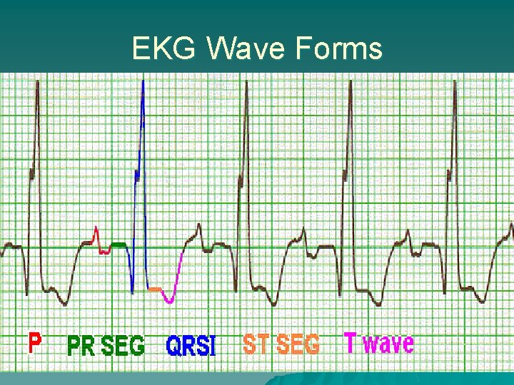 EKG Wave Forms 