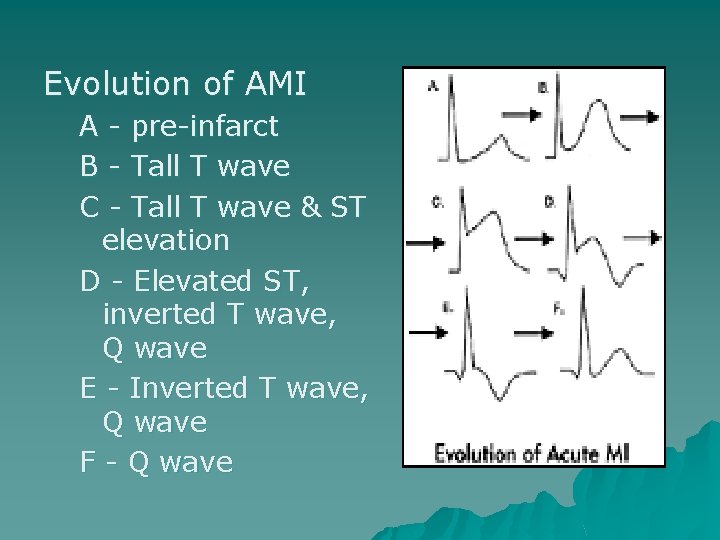 Evolution of AMI A - pre-infarct B - Tall T wave C - Tall