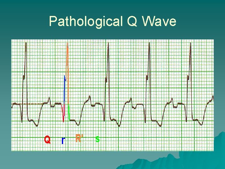 Pathological Q Wave 