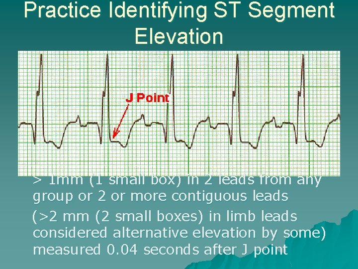 Practice Identifying ST Segment Elevation > 1 mm (1 small box) in 2 leads