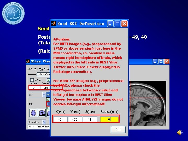 Seed Region Posterior Cingulate Cortex (PCC): − 5, − 49, 40 (Talairach coordinates) (Raichle