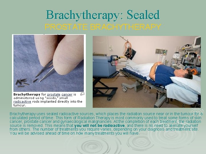 Brachytherapy: Sealed PROSTATE BRACHYTHERAPY Brachytherapy uses sealed radioactive sources, which places the radiation source