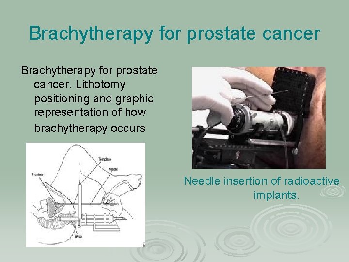 Brachytherapy for prostate cancer. Lithotomy positioning and graphic representation of how brachytherapy occurs Needle