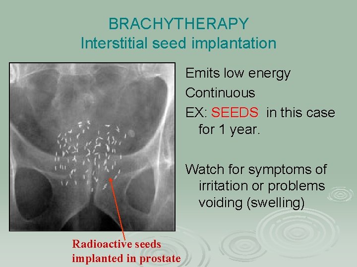 BRACHYTHERAPY Interstitial seed implantation Emits low energy Continuous EX: SEEDS in this case for