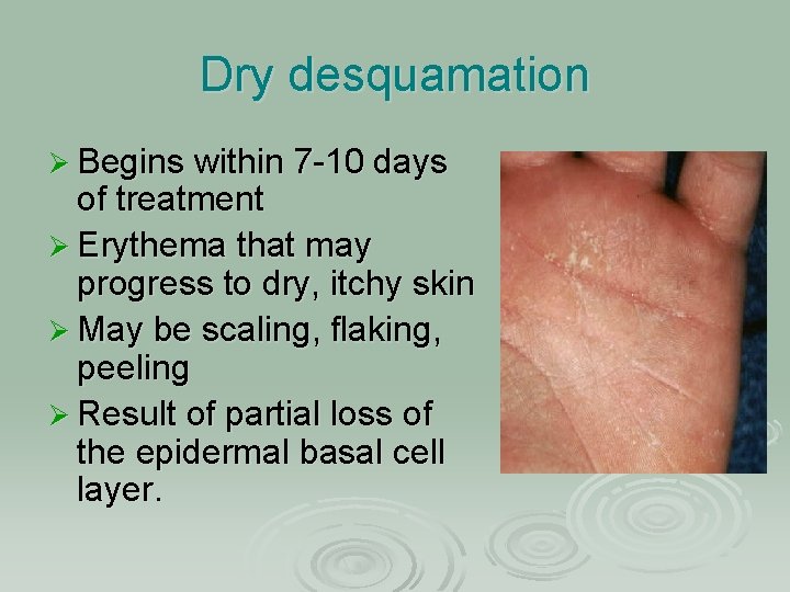 Dry desquamation Ø Begins within 7 -10 days of treatment Ø Erythema that may