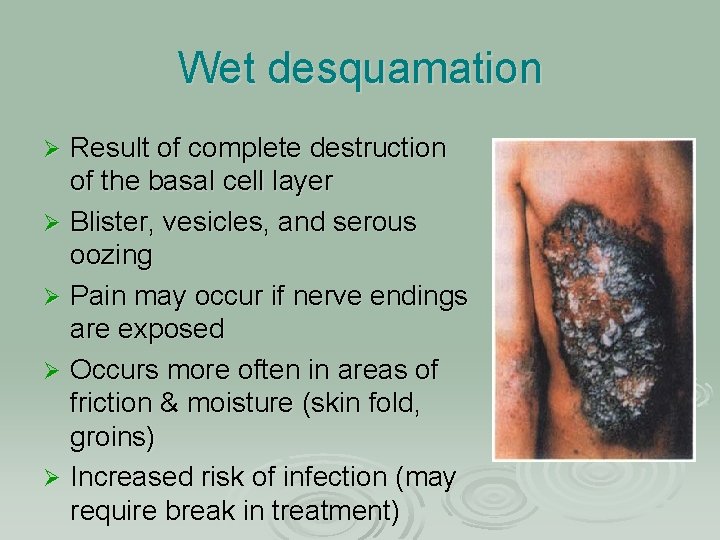 Wet desquamation Result of complete destruction of the basal cell layer Ø Blister, vesicles,