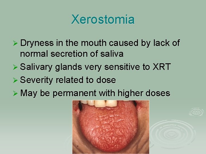 Xerostomia Ø Dryness in the mouth caused by lack of normal secretion of saliva