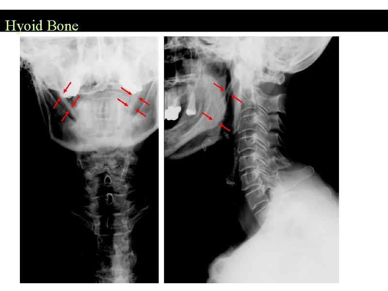 Hyoid Bone 