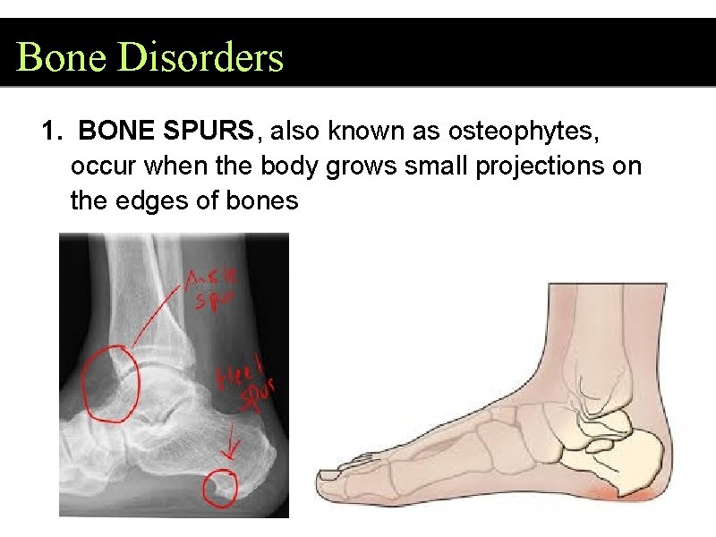 Bone Disorders 1. BONE SPURS, also known as osteophytes, occur when the body grows