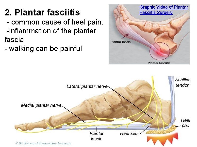 2. Plantar fasciitis - common cause of heel pain. -inflammation of the plantar fascia