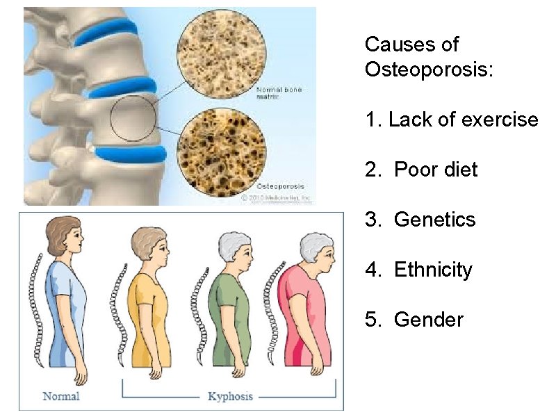 Causes of Osteoporosis: 1. Lack of exercise 2. Poor diet 3. Genetics 4. Ethnicity