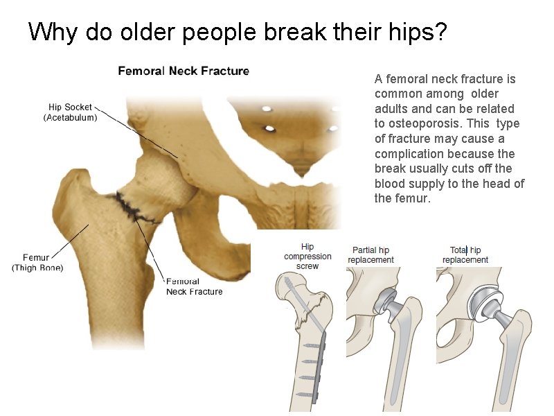 Why do older people break their hips? A femoral neck fracture is common among