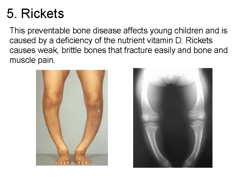 5. Rickets This preventable bone disease affects young children and is caused by a