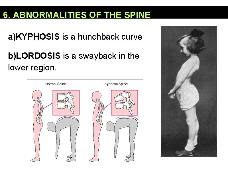 6. ABNORMALITIES OF THE SPINE a)KYPHOSIS is a hunchback curve b)LORDOSIS is a swayback