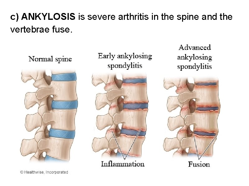 c) ANKYLOSIS is severe arthritis in the spine and the vertebrae fuse. 