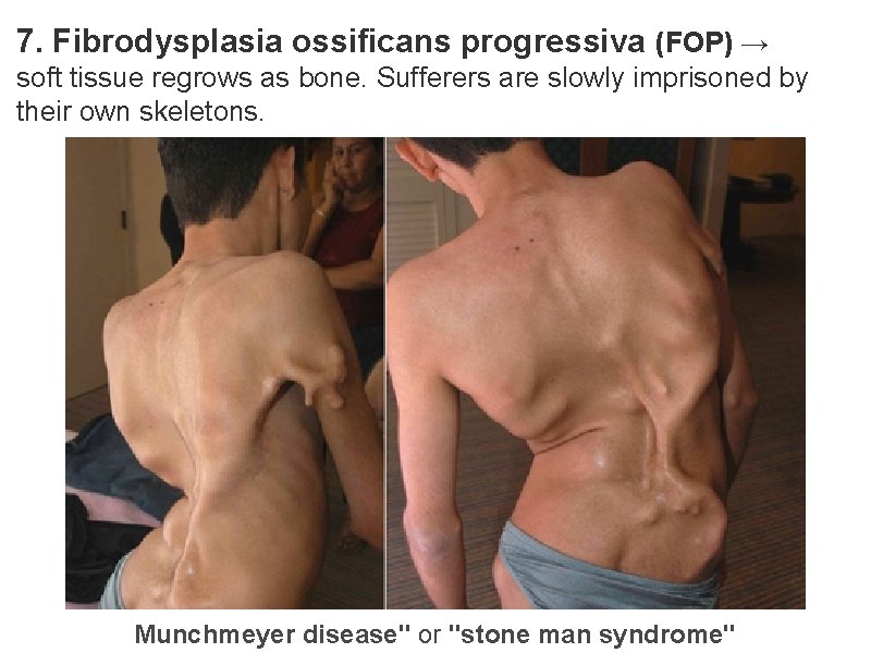 7. Fibrodysplasia ossificans progressiva (FOP) → soft tissue regrows as bone. Sufferers are slowly