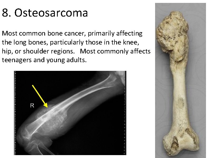 8. Osteosarcoma Most common bone cancer, primarily affecting the long bones, particularly those in