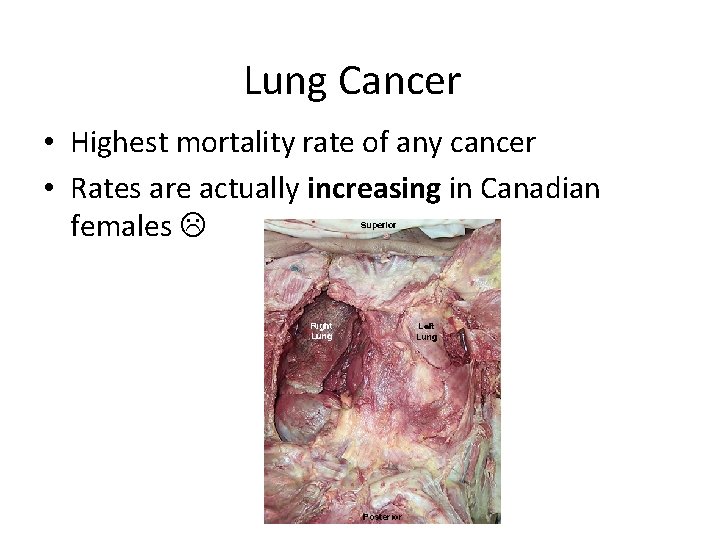 Lung Cancer • Highest mortality rate of any cancer • Rates are actually increasing