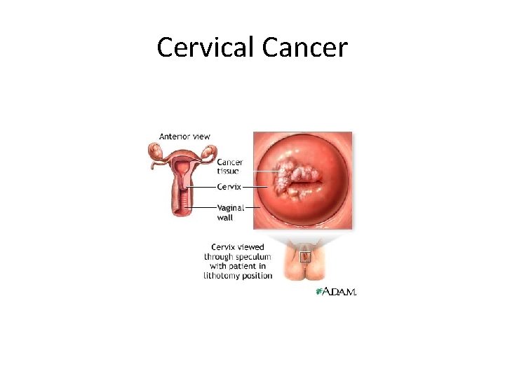 Cervical Cancer 