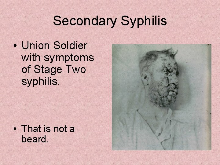 Secondary Syphilis • Union Soldier with symptoms of Stage Two syphilis. • That is