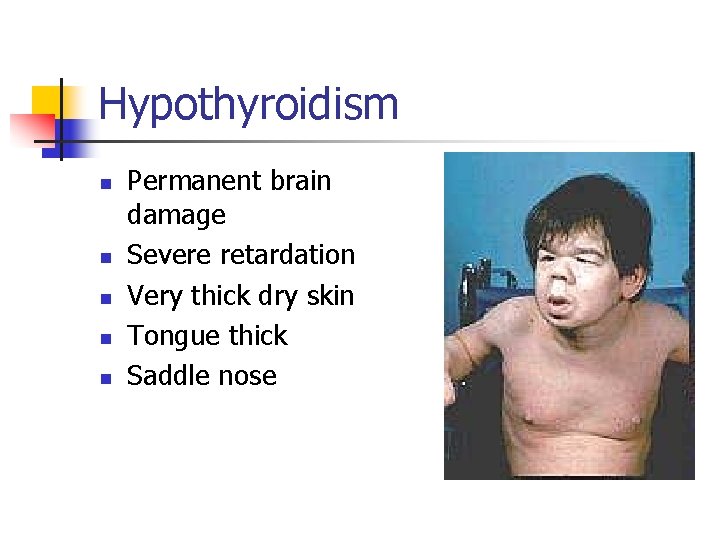 Hypothyroidism n n n Permanent brain damage Severe retardation Very thick dry skin Tongue