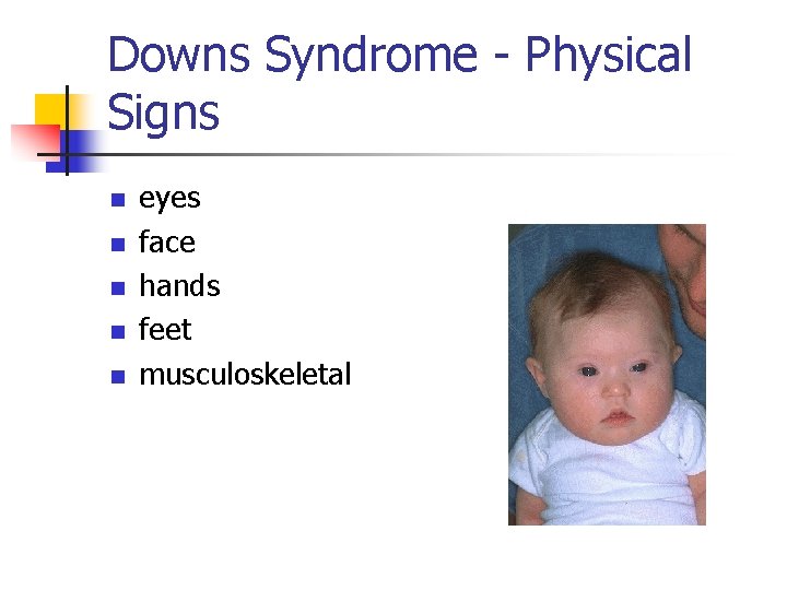 Downs Syndrome - Physical Signs n n n eyes face hands feet musculoskeletal 