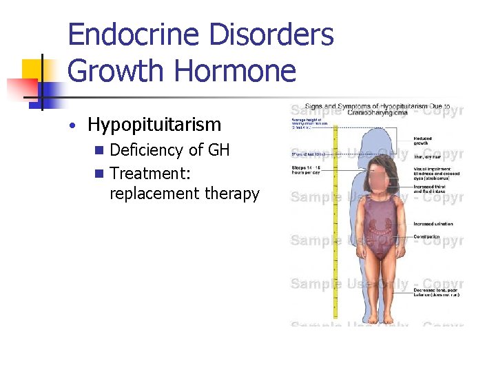 Endocrine Disorders Growth Hormone • Hypopituitarism n Deficiency of GH n Treatment: replacement therapy