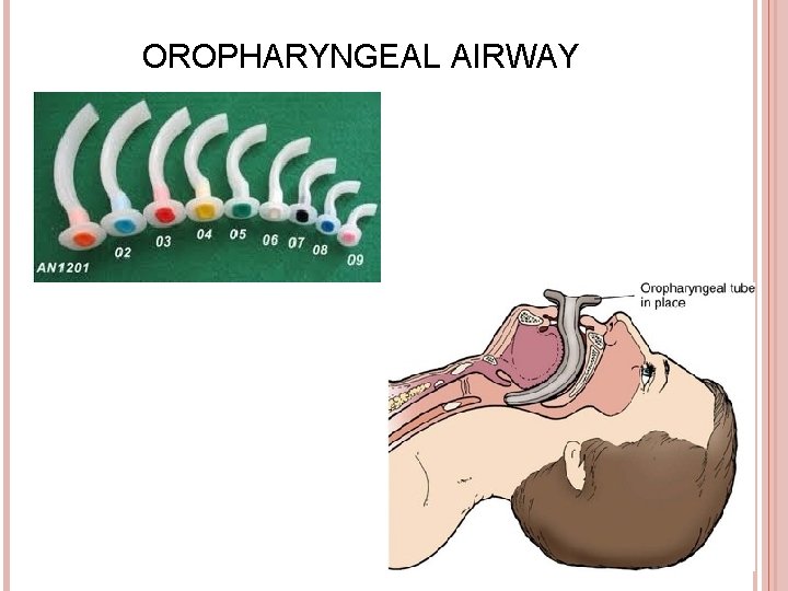 OROPHARYNGEAL AIRWAY 