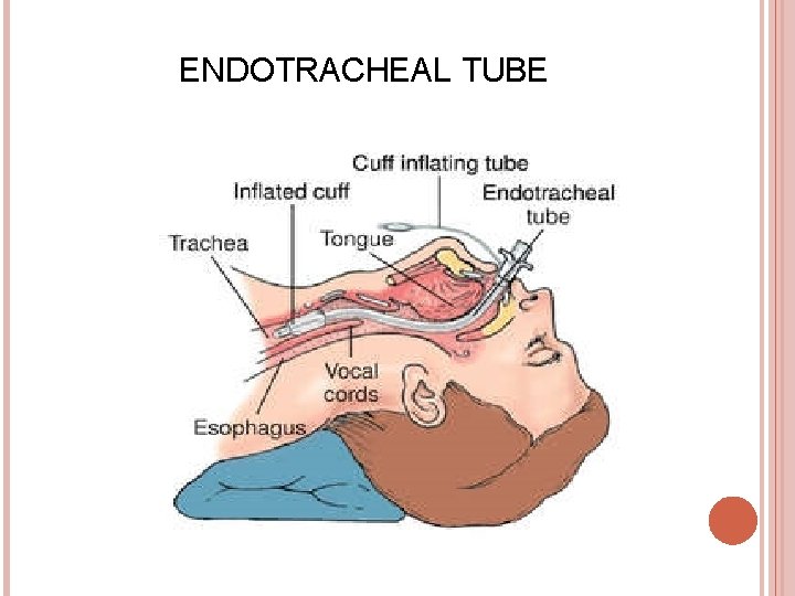ENDOTRACHEAL TUBE 