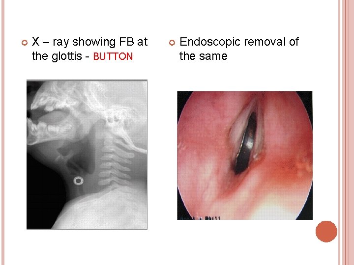  X – ray showing FB at the glottis - BUTTON Endoscopic removal of
