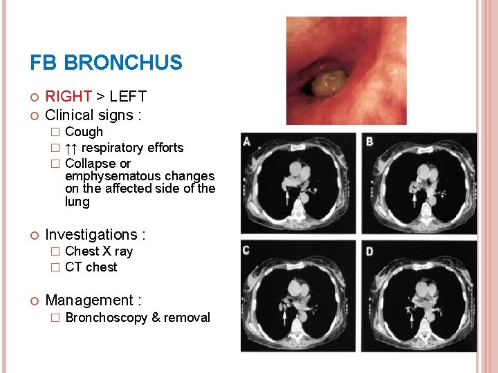 FB BRONCHUS RIGHT > LEFT Clinical signs : � � � Investigations : �