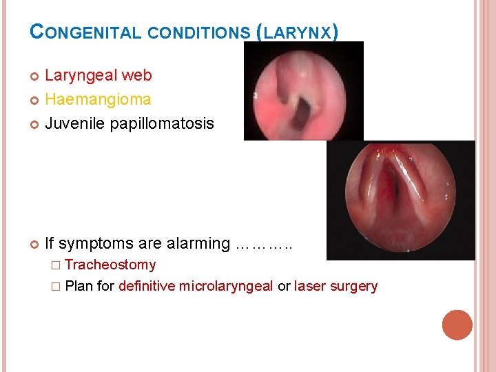 CONGENITAL CONDITIONS (LARYNX) Laryngeal web Haemangioma Juvenile papillomatosis If symptoms are alarming ………. .