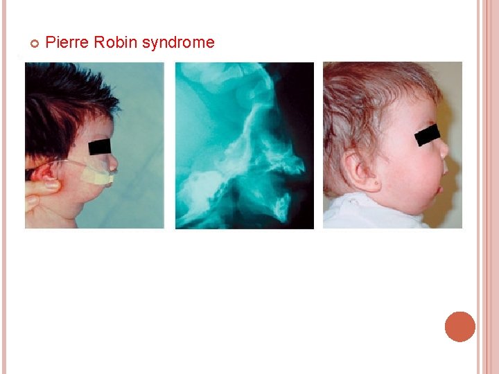  Pierre Robin syndrome Treacher Collin Syndrome 